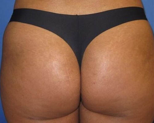 Same client after an external buttock-contouring course; result not guaranteed