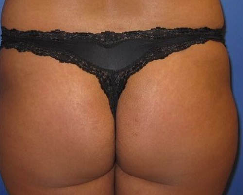 Client before a Glasgow-style external buttock-contouring course