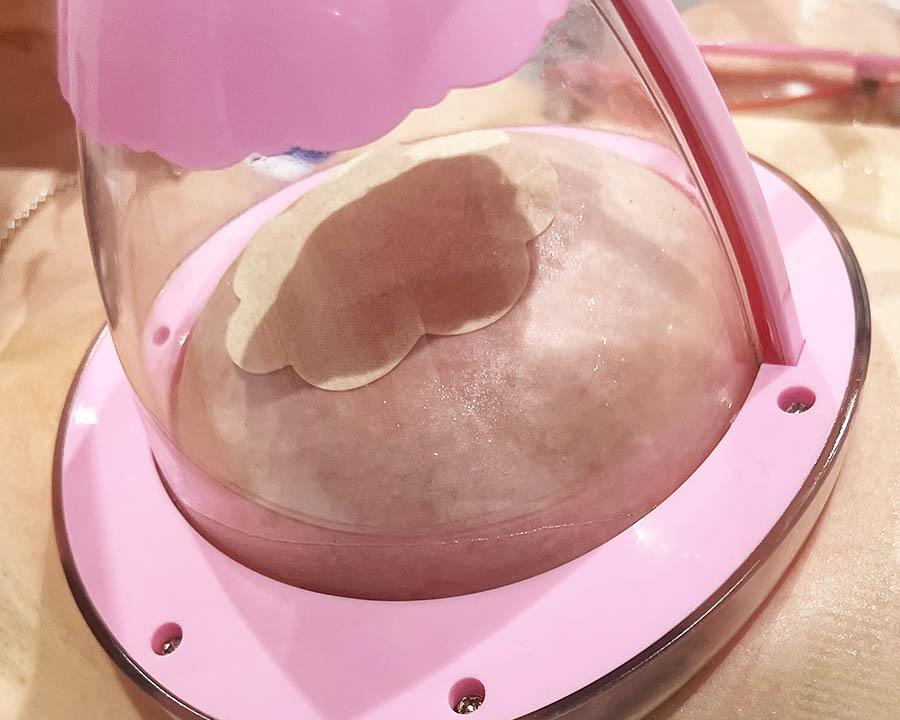 Vacuum cup treatment being performed in a clinic setting