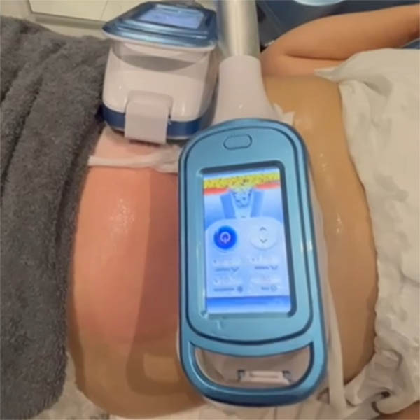 Fat-freezing applicator held beside a body-contouring treatment area