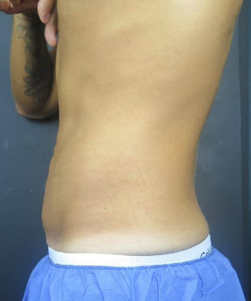 Abdominal profile before a previous cryolipolysis course