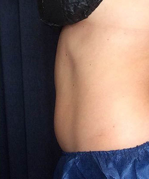 Stomach area after follow-up photography