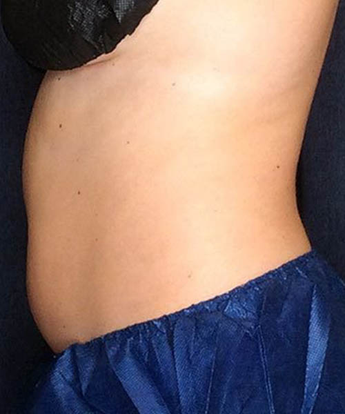 Stomach area before a previous cooling treatment