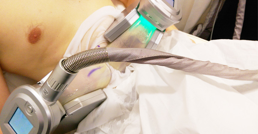Cryolipolysis applicator attached to a mapped abdominal area