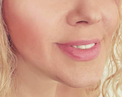The same client’s facial profile at follow-up