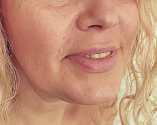 Client’s facial profile before HIFU treatment
