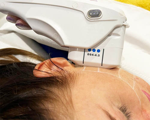 HIFU handpiece moved methodically across a mapped jawline