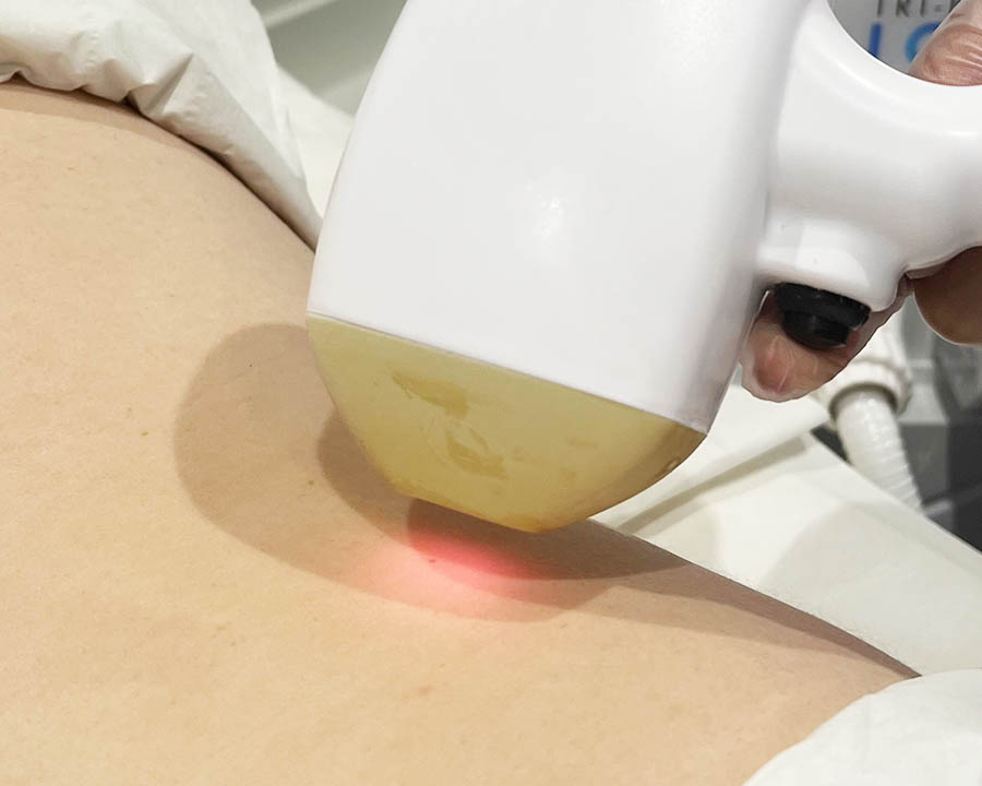 Laser handpiece used on a suitable body area in the Glasgow studio