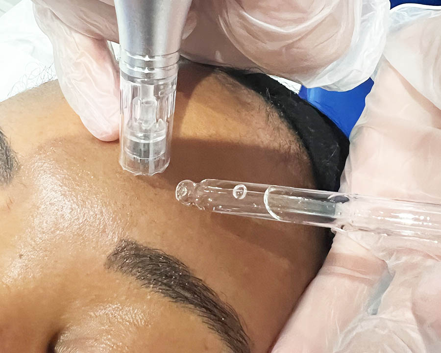 Professional microneedling pen used on facial skin in the Glasgow studio