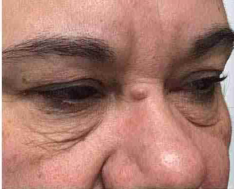 Client’s treatment area before a Morpheus8 procedure