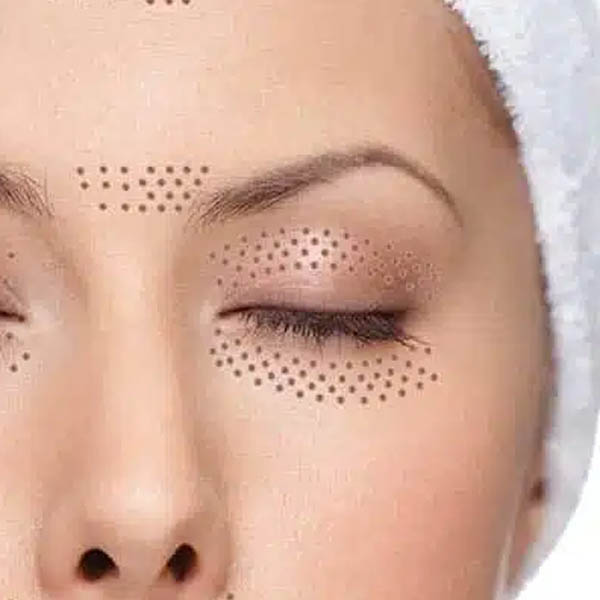 Practitioner creating controlled plasma points near the eyelid in Glasgow