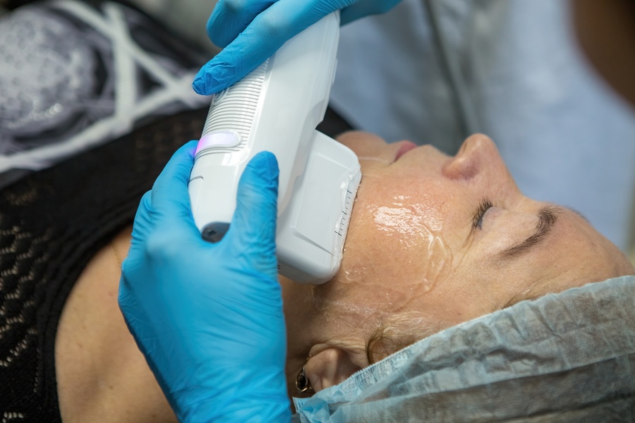 Morpheus8 handpiece applied to a mapped facial area during a Glasgow procedure